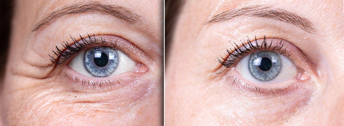 Eye Bags & Dark Circles Treatment