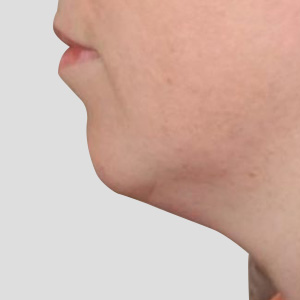 Jaw contouring or Botulinum Toxin jaw reduction