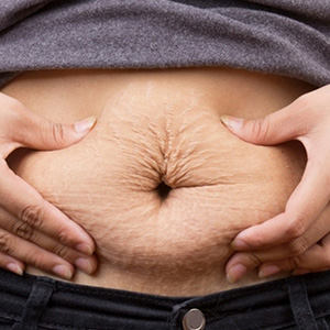 Excess flab on stomach